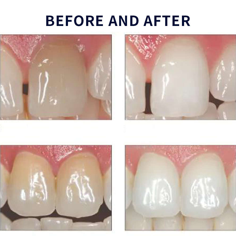 Opalescentie Whitening 20% Pf  - Teeth Whitening In Office recensie en prijs