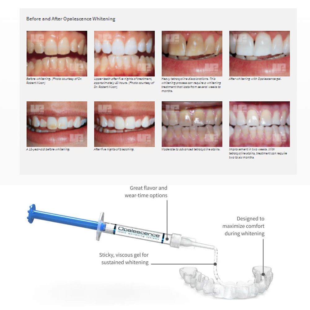 Opalescentie Whitening 20% Pf  - Teeth Whitening In Office recensie en prijs