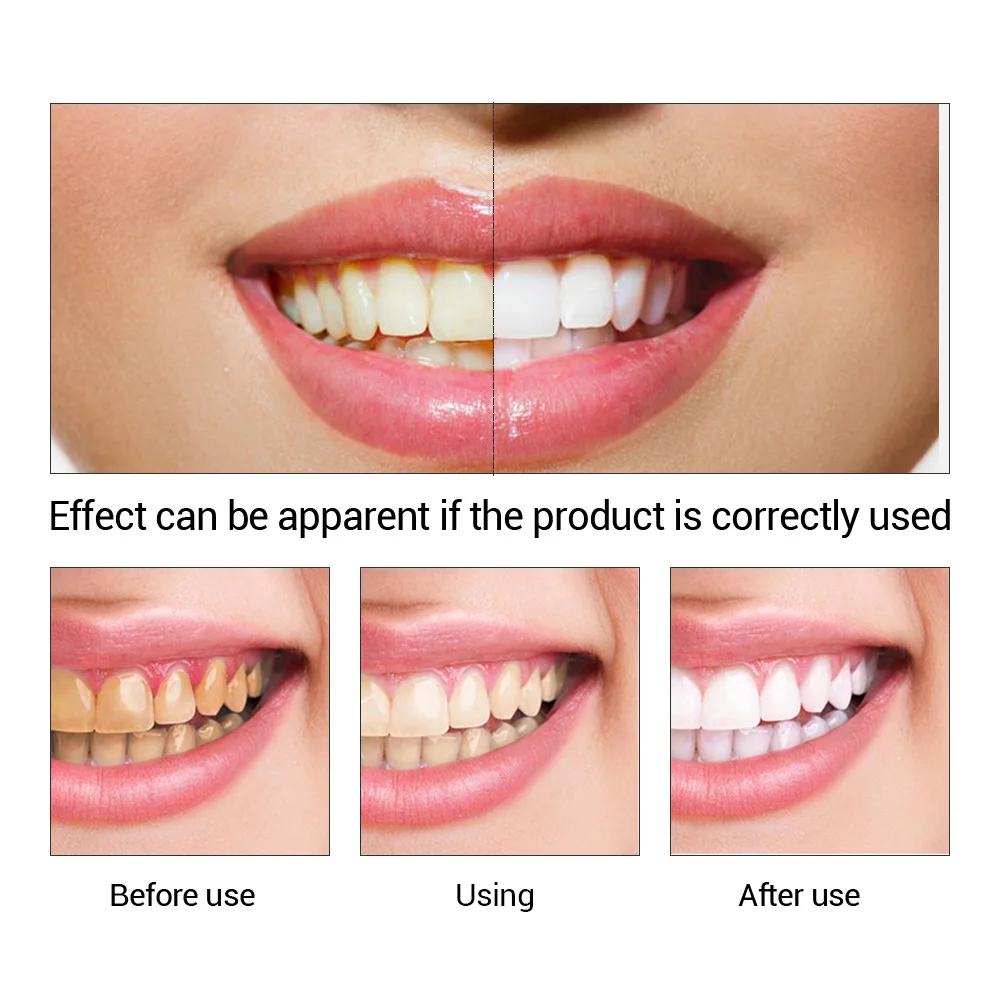 Fteenply Tanden Whitening Esse - Teeth Whitening Treatment recensie en prijs